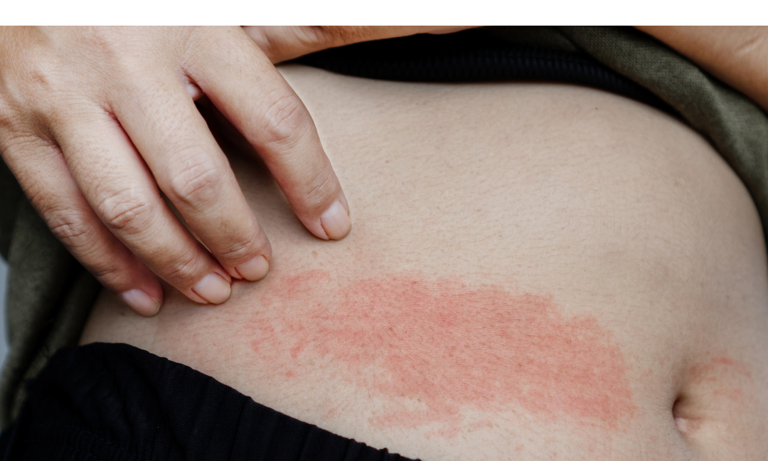 Protective Healing: How to Support Your Skin After Scratching