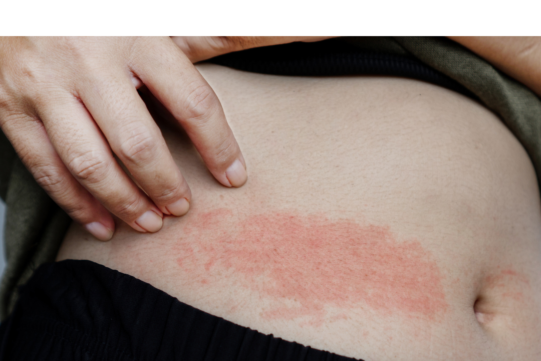 Protective Healing: How to Support Your Skin After Scratching