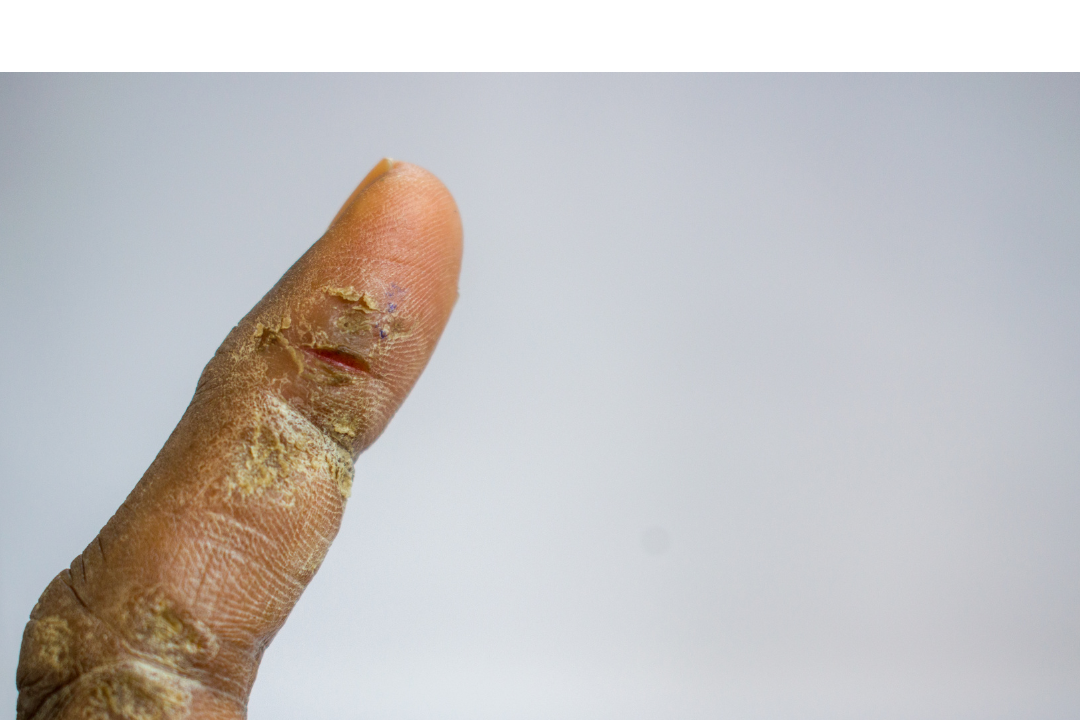 No Moisture Therapy (NMT): Why Withholding Moisture Can Help Heal Your Skin Barrier