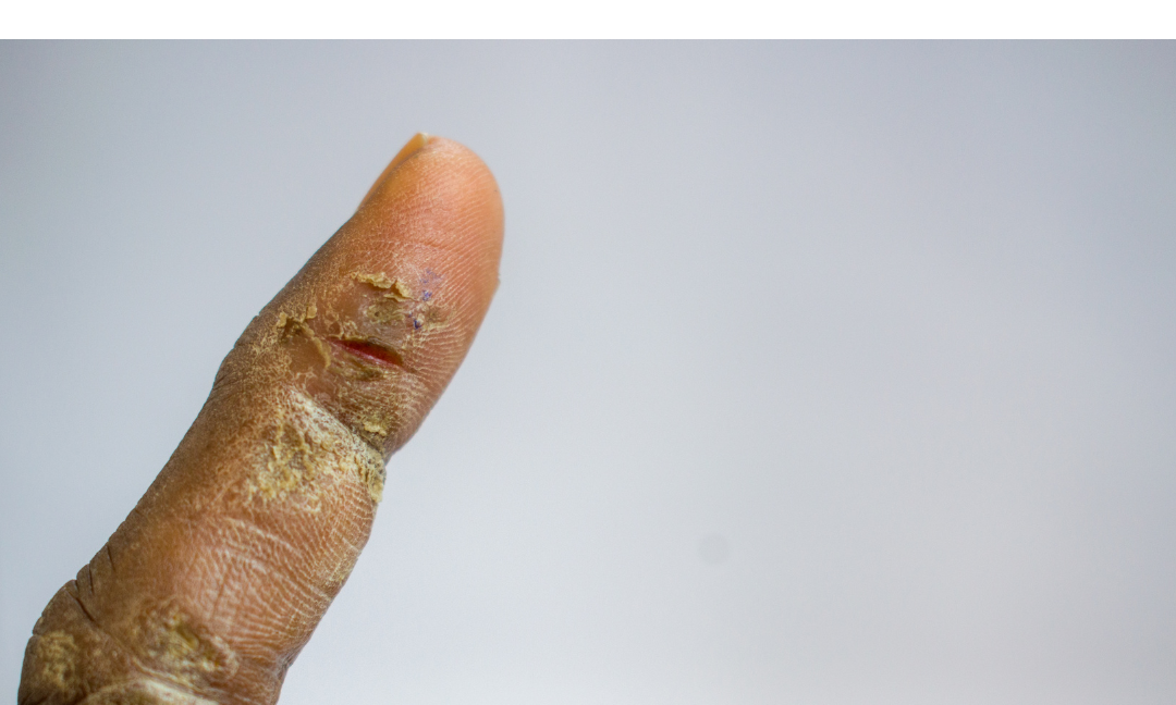 No Moisture Therapy (NMT): Why Withholding Moisture Can Help Heal Your Skin Barrier