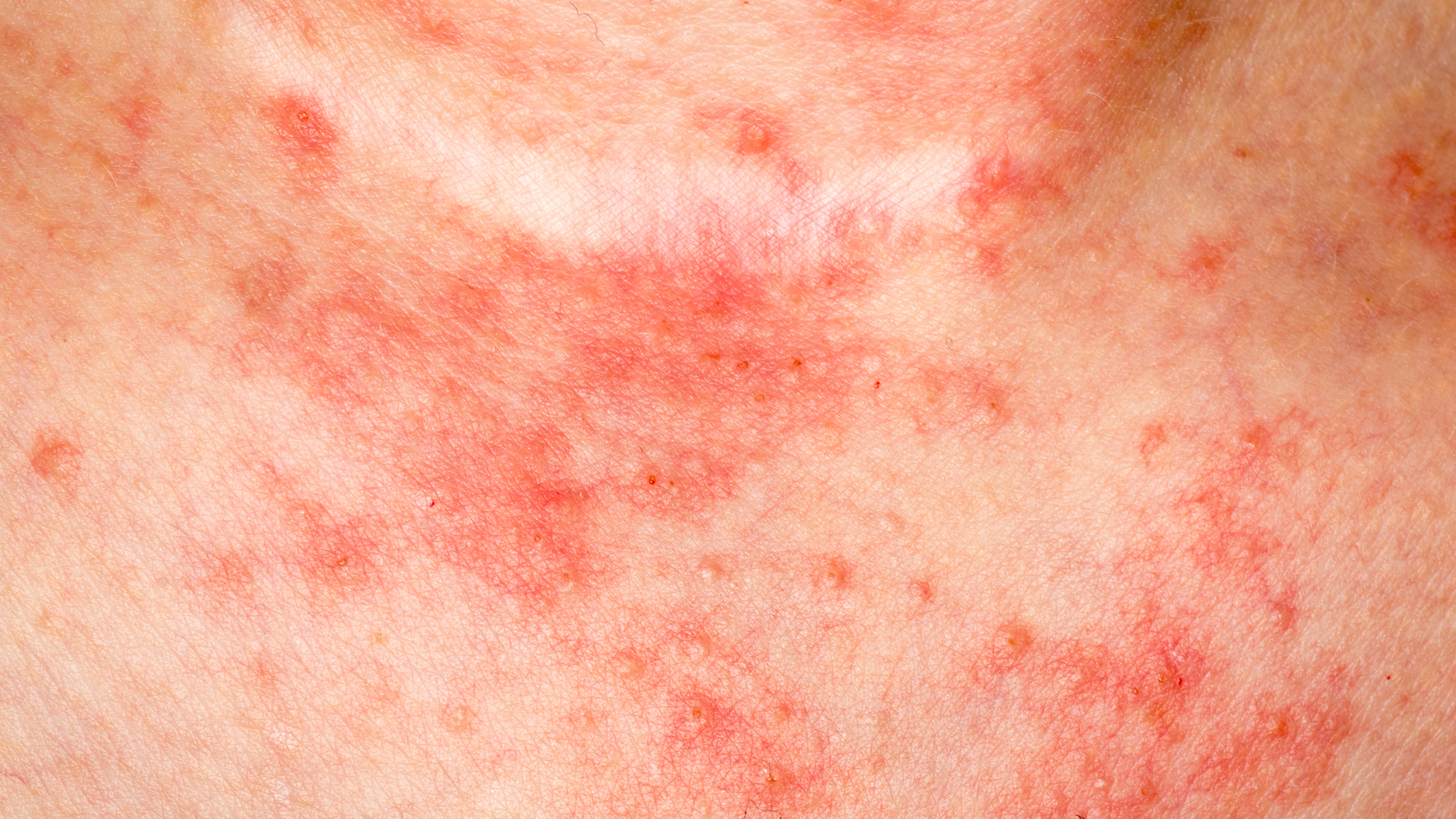 How To Treat Inflammation and Flare ups – everbella